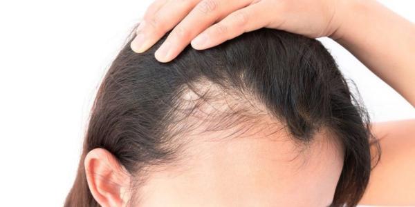 کدام ویتامین ها در درمان ریزش مو موثر هستند؟